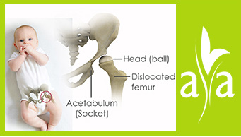 Developmental-Dysplasia of Hip