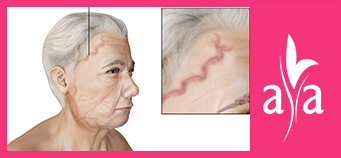 Giant Cell Arteritis