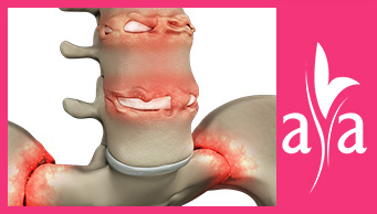 Ankylosing Spondylitis