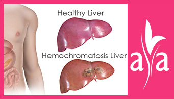 Hemochromatosis