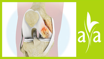 Infectious Arthritis