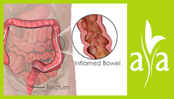 Inflammatory Bowel Disease