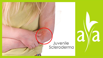 Juvenile Scleroderma