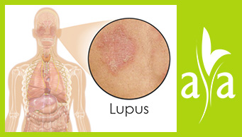 Lupus