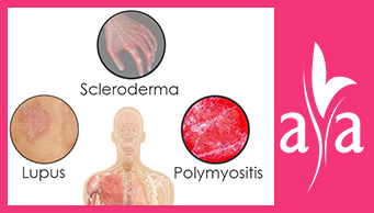 Mixed Connective Tissue Disease