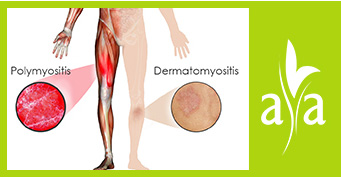 Myositis (inc. Polymyositis, Dermatomyositis)
