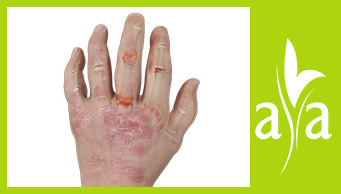 Psoriatic Arthritis