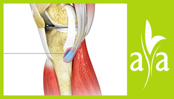 Bursitis