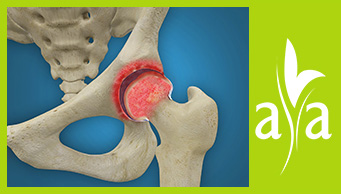 Rheumatoid Arthritis